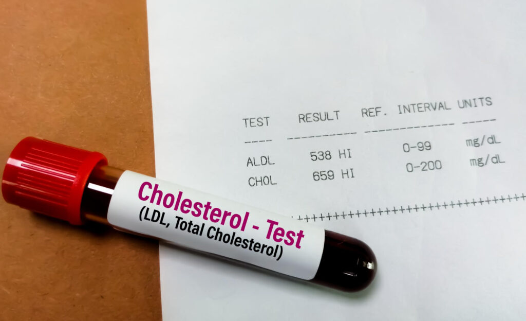 Blood sample tube labeled Cholesterol Test lies on a medical report showing LDL and HDL results (ALDL 538 HI, CHOL 659 HI).